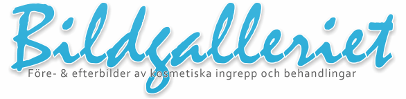 Före och efter bilder bröstförminskning Bilder före och efter bröstförminskningar