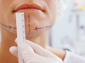 En hakförstoring utförs i syfte att åstadkomma en bättre balans i ansiktet eller för att förstärka patientens profil