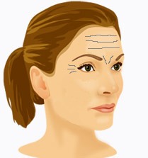 Behandling med Botox (Vistabel/Dysport) De vanligaste behandlingsområdena för Botox är pannrynkor, glabellarynkor och kråksparkar