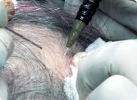 Hålstickning inför hårtransplantation