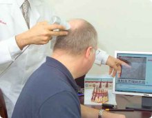Konsultation inför en hårtransplantation