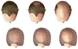 Manligt håravfall (androgen alopeci) kan öven drabba kvinnor Manligt håravfall (androgen alopeci) kan öven drabba kvinnor