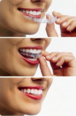 Invisalign tandställning