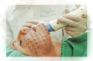 Thermage